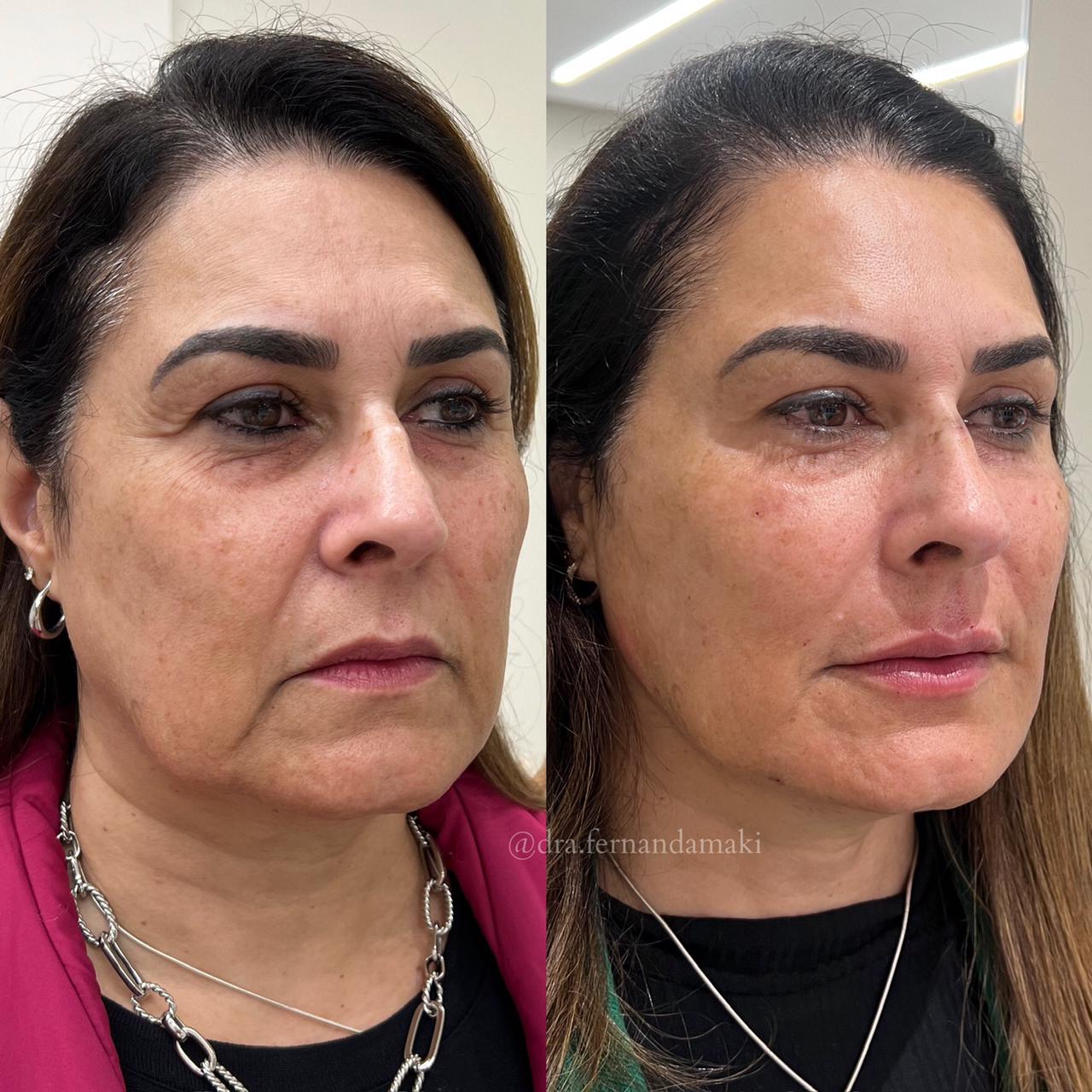 Antes e depois — Rejuvenescimento